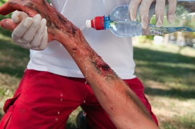 Cooling seriously burned hand with water. First aid training, realistic injury makeup